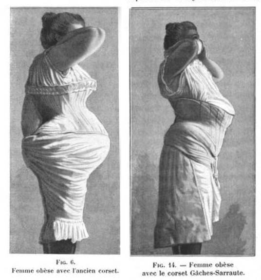 The old style corset versus the Gâches-Sarraute corset